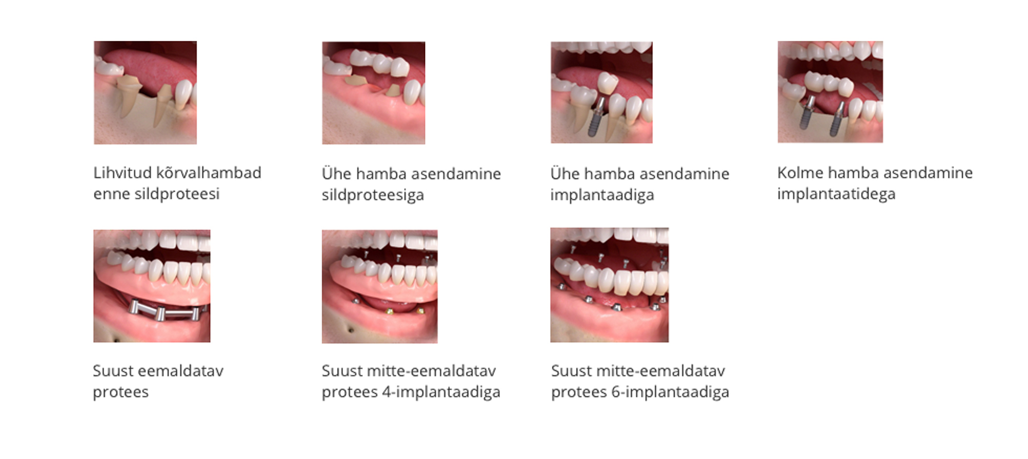 Implantatsioon ja selle variandid